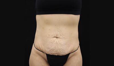 Abdominoplasty Before & After Gallery - Patient 147104947 - Image 1