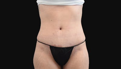 Abdominoplasty Before & After Gallery - Patient 147104947 - Image 2
