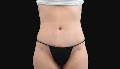 Abdominoplasty Before & After Gallery - Patient 147104947 - Image 2