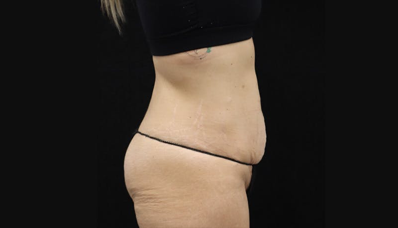 Abdominoplasty Before & After Gallery - Patient 147104947 - Image 3