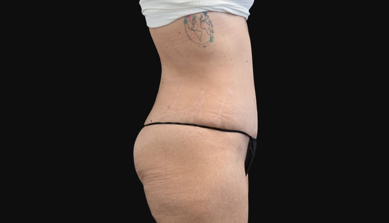 Abdominoplasty Before & After Gallery - Patient 147104947 - Image 4