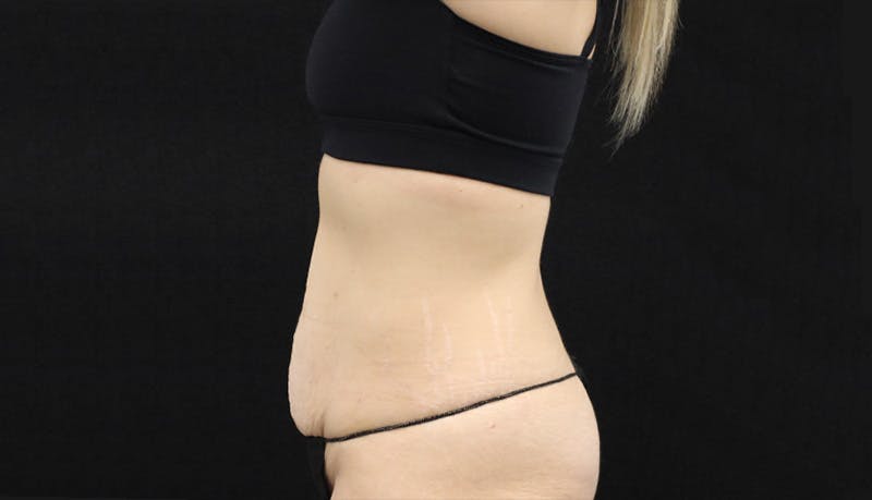 Abdominoplasty Before & After Gallery - Patient 147104947 - Image 5