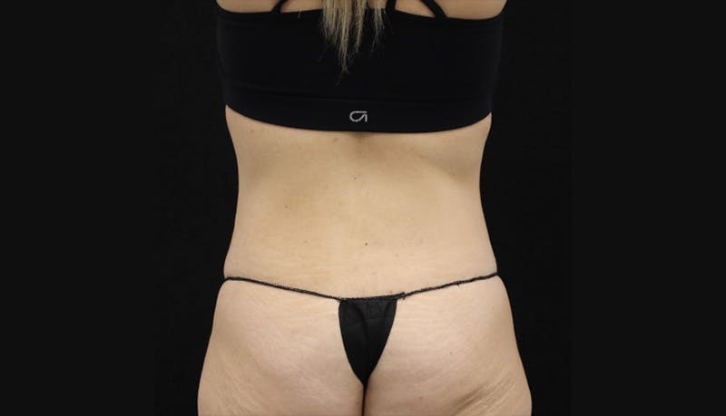 Abdominoplasty Before & After Gallery - Patient 147104947 - Image 7