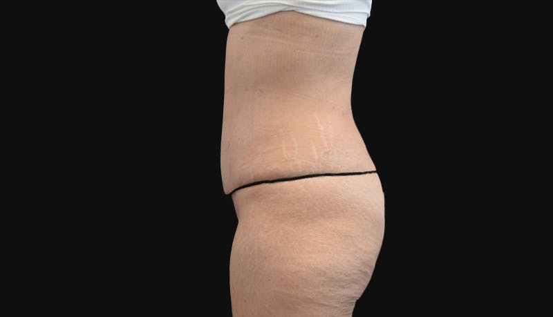 Abdominoplasty Before & After Gallery - Patient 147104947 - Image 6