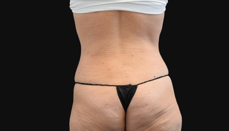 Abdominoplasty Before & After Gallery - Patient 147104947 - Image 8