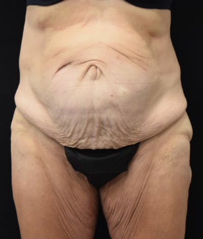 Lower Body Lift Before & After Gallery - Patient 147393396 - Image 1