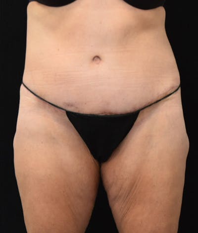 Lower Body Lift Before & After Gallery - Patient 147393396 - Image 2