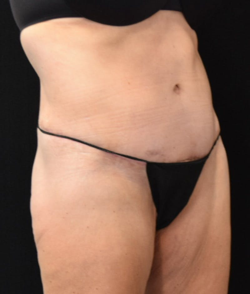 Lower Body Lift Before & After Gallery - Patient 147393396 - Image 4