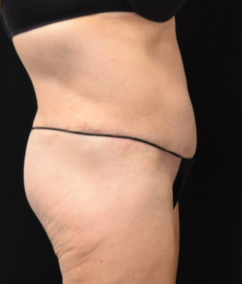 Lower Body Lift Before & After Gallery - Patient 147393396 - Image 6