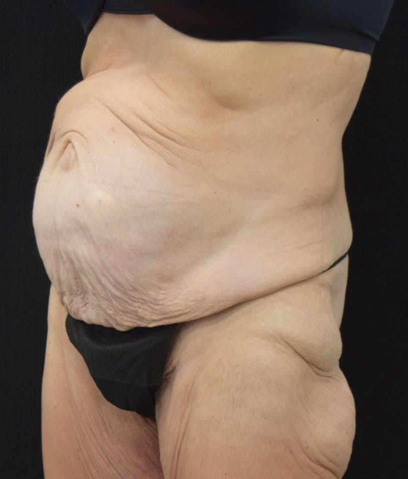 Lower Body Lift Before & After Gallery - Patient 147393396 - Image 7