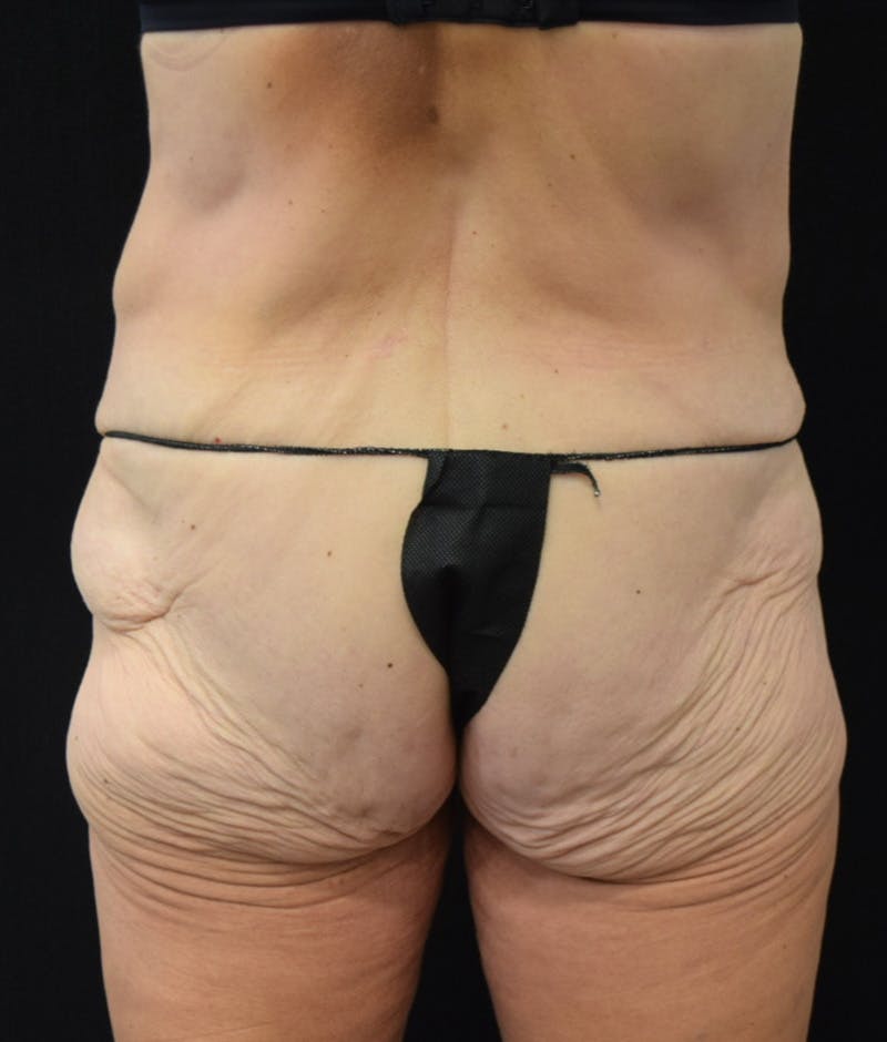 Lower Body Lift Before & After Gallery - Patient 147393396 - Image 11