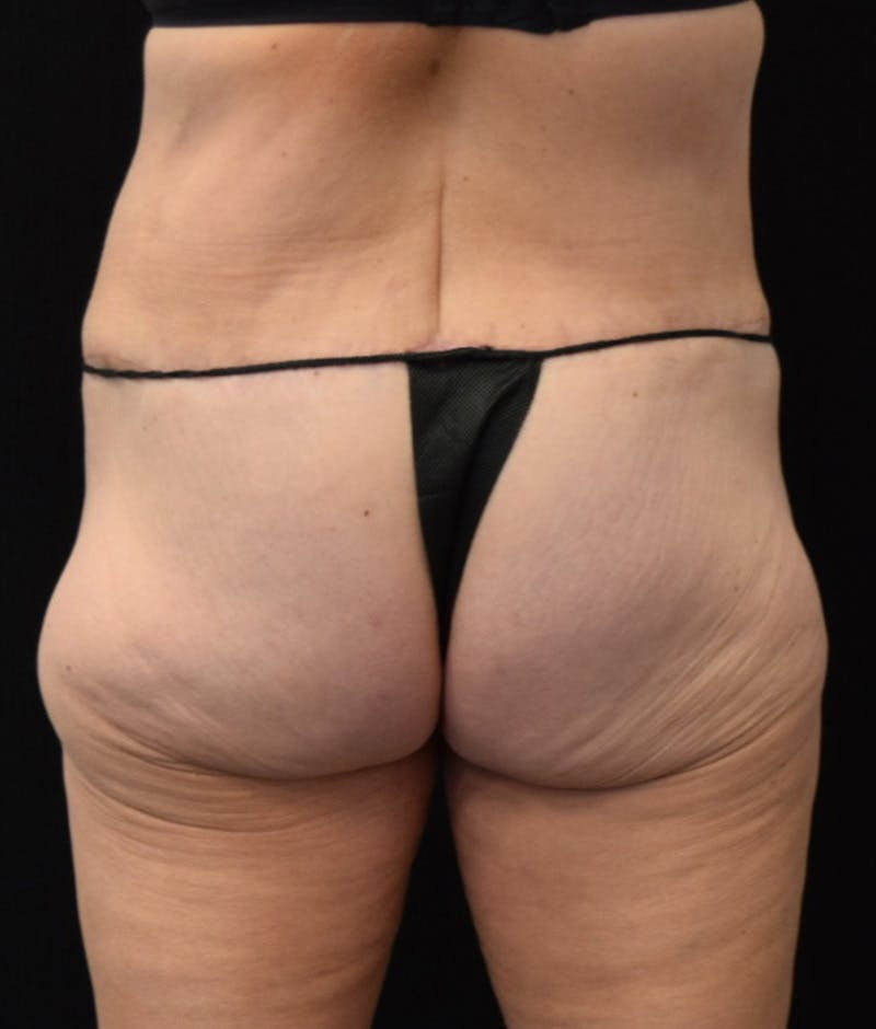 Lower Body Lift Before & After Gallery - Patient 147393396 - Image 12