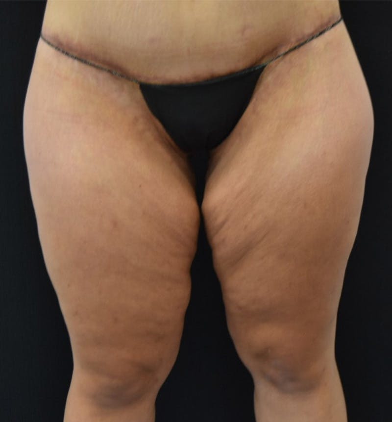 Thigh Lift Before & After Gallery - Patient 148147952 - Image 1