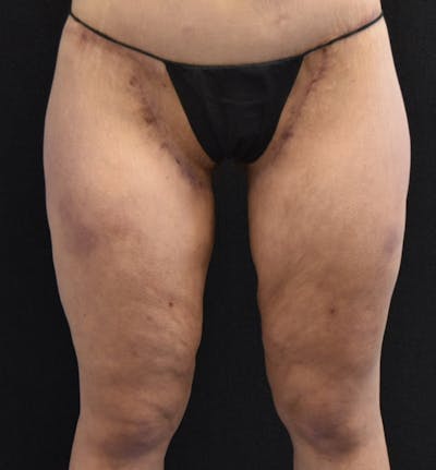 Thigh Lift Before & After Gallery - Patient 148147952 - Image 2