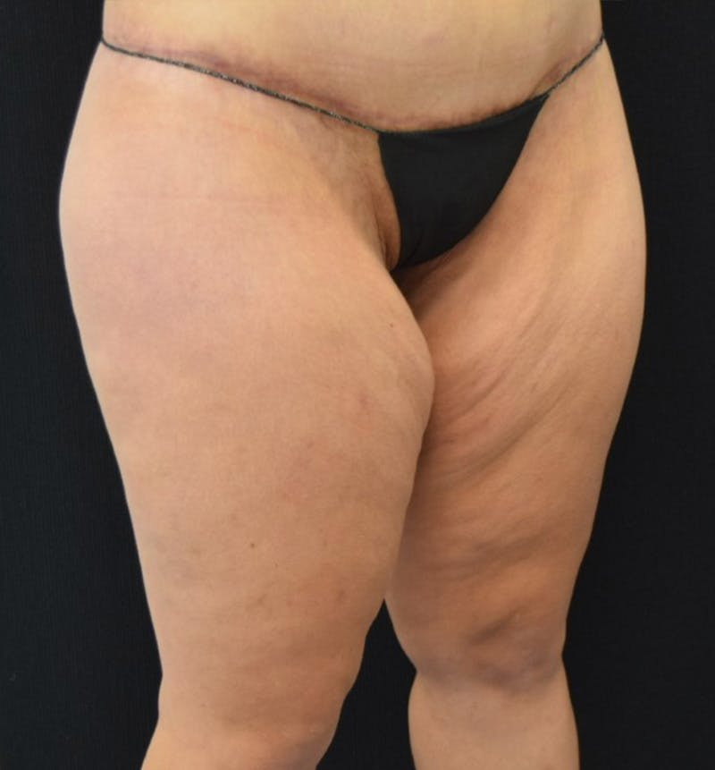 Thigh Lift Before & After Gallery - Patient 148147952 - Image 3