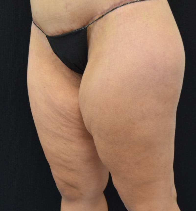 Thigh Lift Before & After Gallery - Patient 148147952 - Image 5