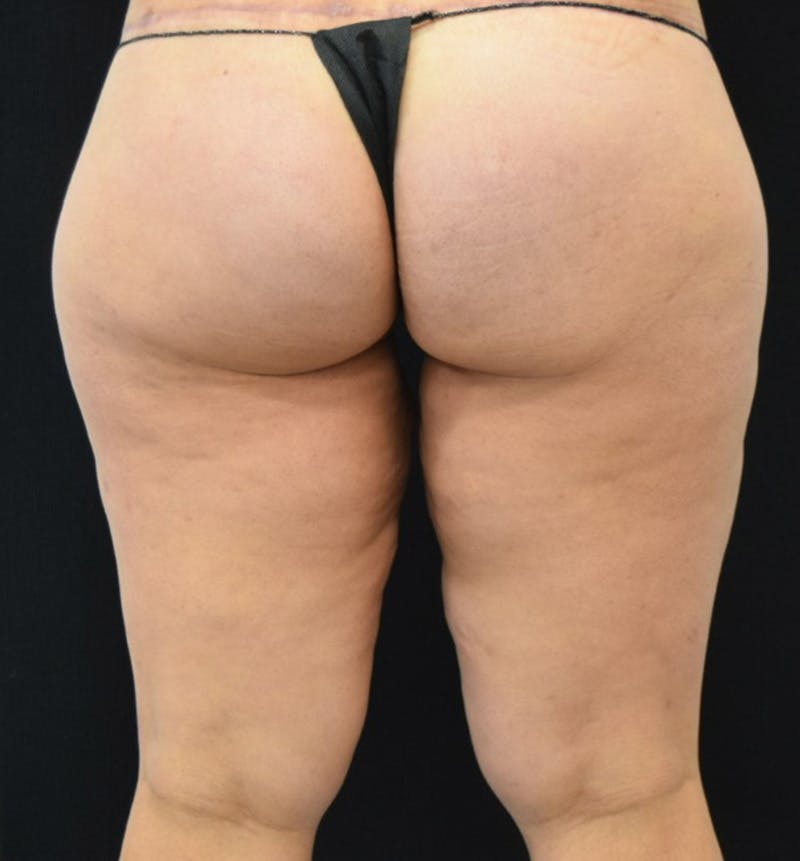 Thigh Lift Before & After Gallery - Patient 148147952 - Image 7