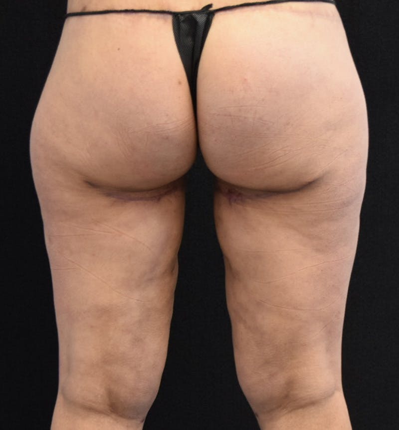Thigh Lift Before & After Gallery - Patient 148147952 - Image 8