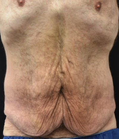Male Lower Body Lift Before & After Gallery - Patient 148291445 - Image 1