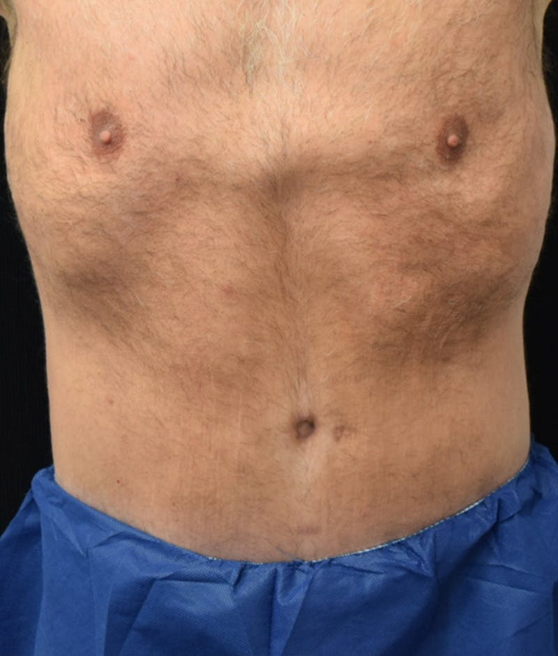 Male Lower Body Lift Before & After Gallery - Patient 148291445 - Image 2