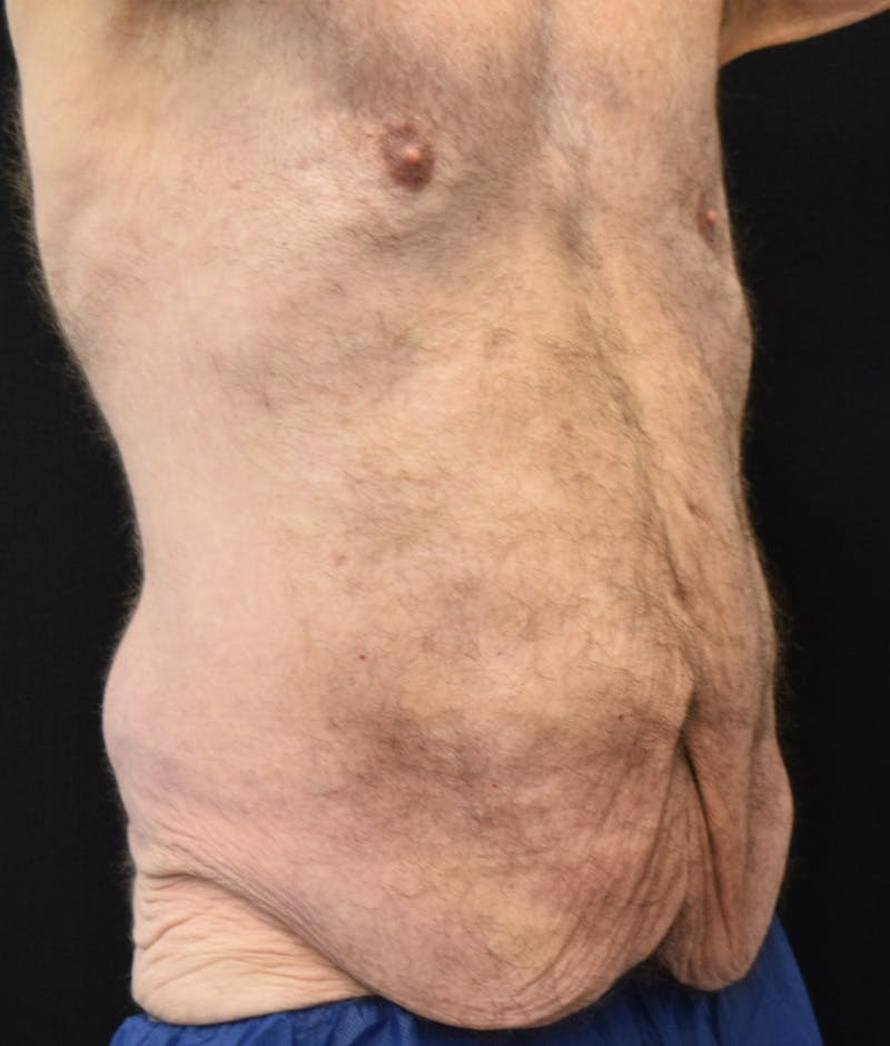 Male Lower Body Lift Before & After Gallery - Patient 148291445 - Image 3