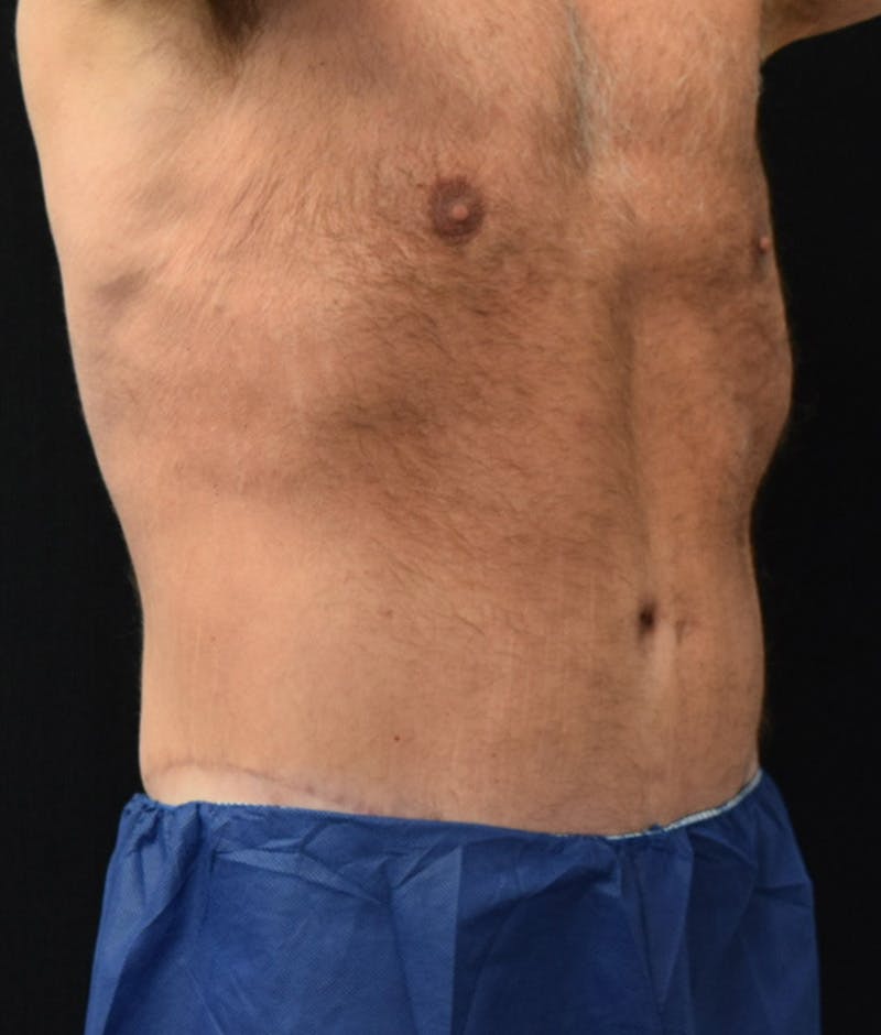 Male Lower Body Lift Before & After Gallery - Patient 148291445 - Image 4