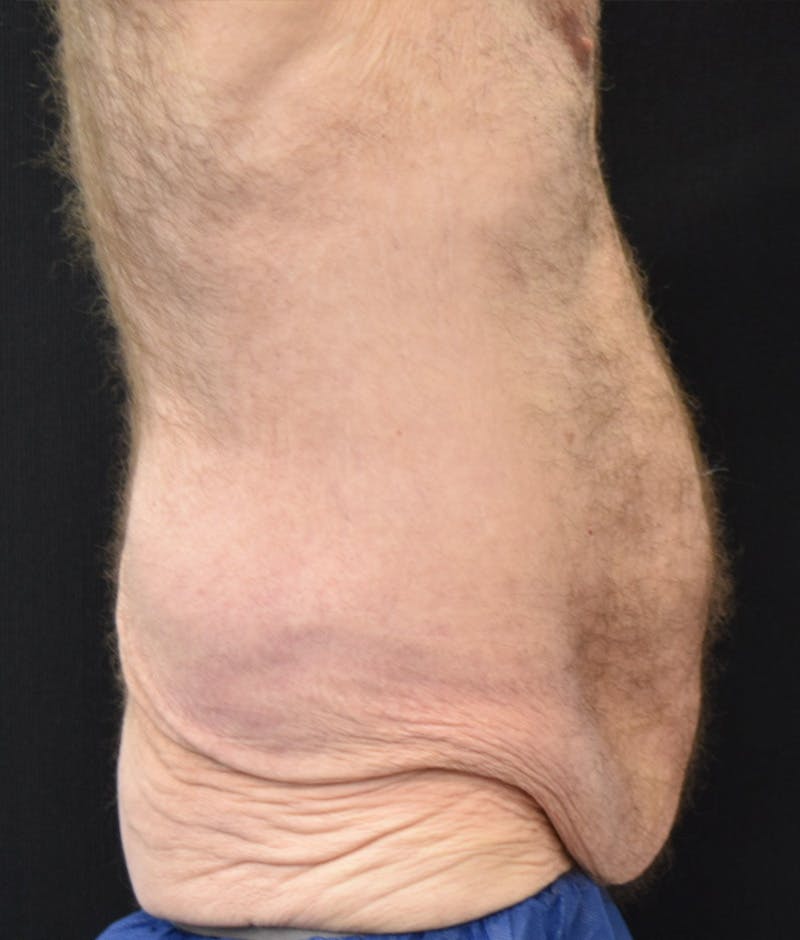 Male Lower Body Lift Before & After Gallery - Patient 148291445 - Image 5