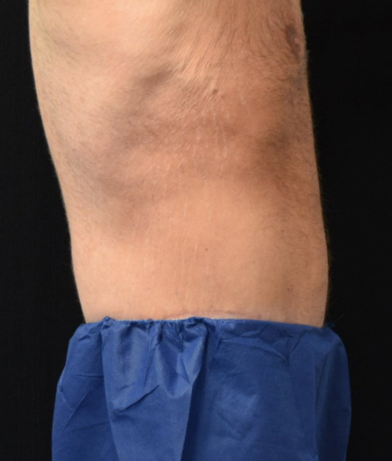 Male Lower Body Lift Before & After Gallery - Patient 148291445 - Image 6