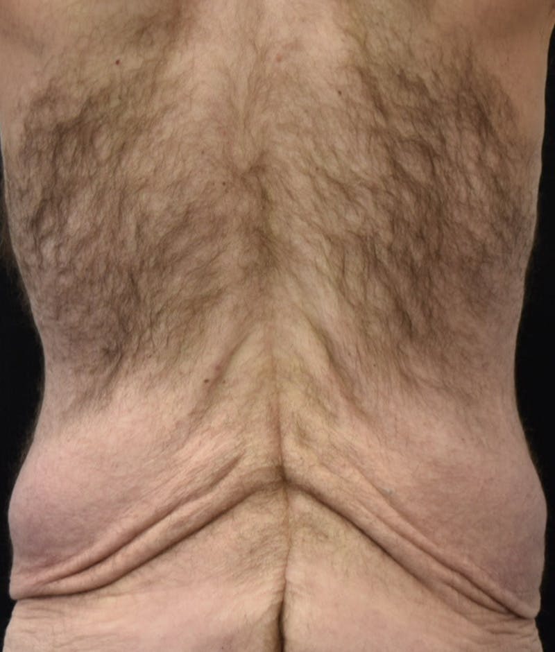 Male Lower Body Lift Before & After Gallery - Patient 148291445 - Image 7