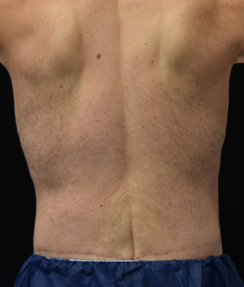 Male Lower Body Lift Before & After Gallery - Patient 148291445 - Image 8