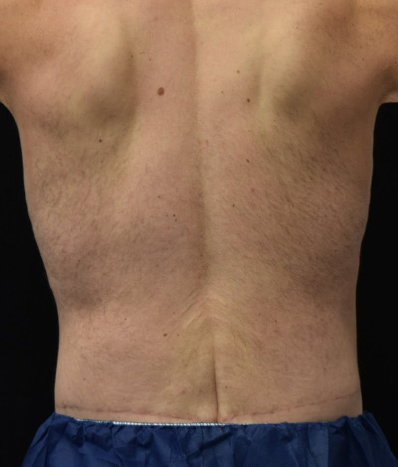 Lower Body Lift Before & After Gallery - Patient 148291445 - Image 8