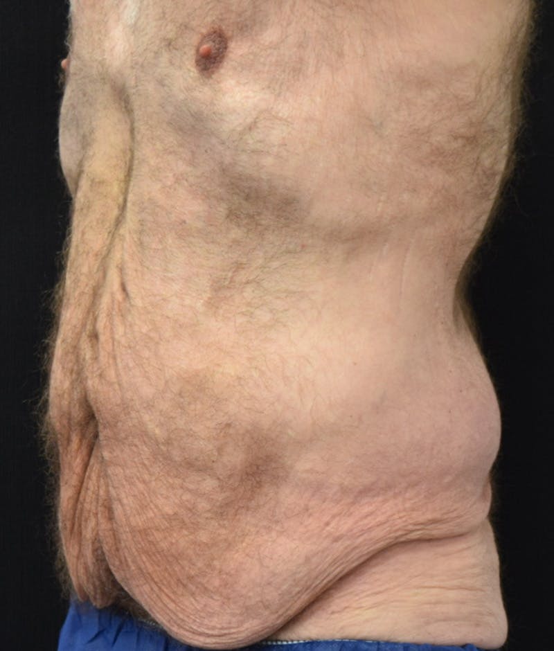 Male Lower Body Lift Before & After Gallery - Patient 148291445 - Image 9