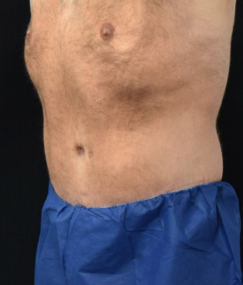 Male Lower Body Lift Before & After Gallery - Patient 148291445 - Image 10