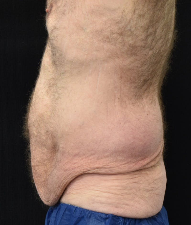 Male Lower Body Lift Before & After Gallery - Patient 148291445 - Image 11