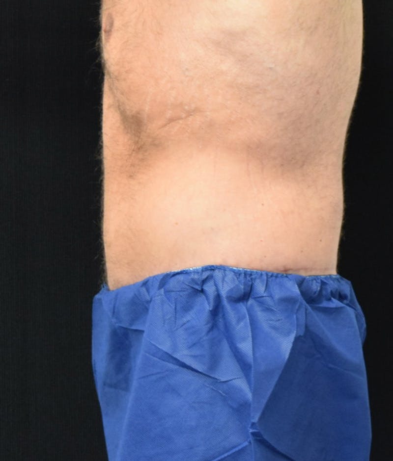 Male Lower Body Lift Before & After Gallery - Patient 148291445 - Image 12
