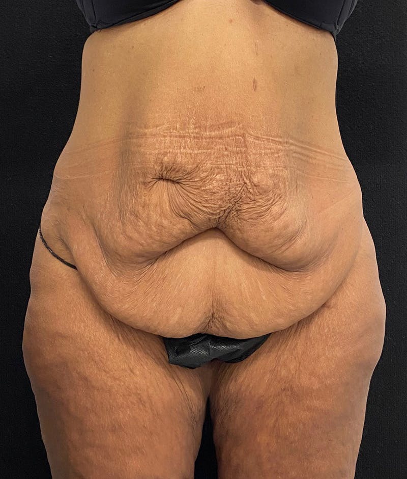 Lower Body Lift Before & After Gallery - Patient 148467571 - Image 1