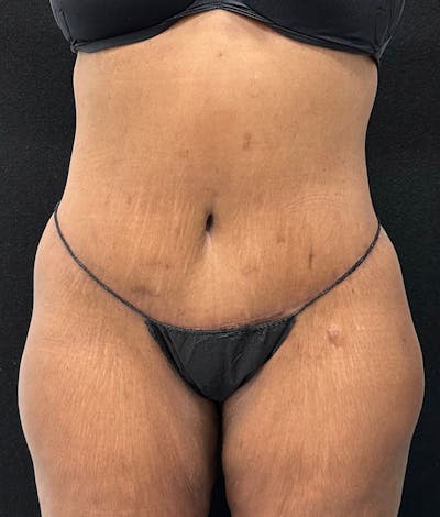 Lower Body Lift Before & After Gallery - Patient 148467571 - Image 2
