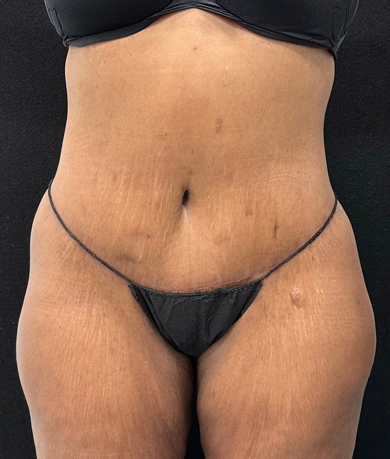 Lower Body Lift Before & After Gallery - Patient 148467571 - Image 2