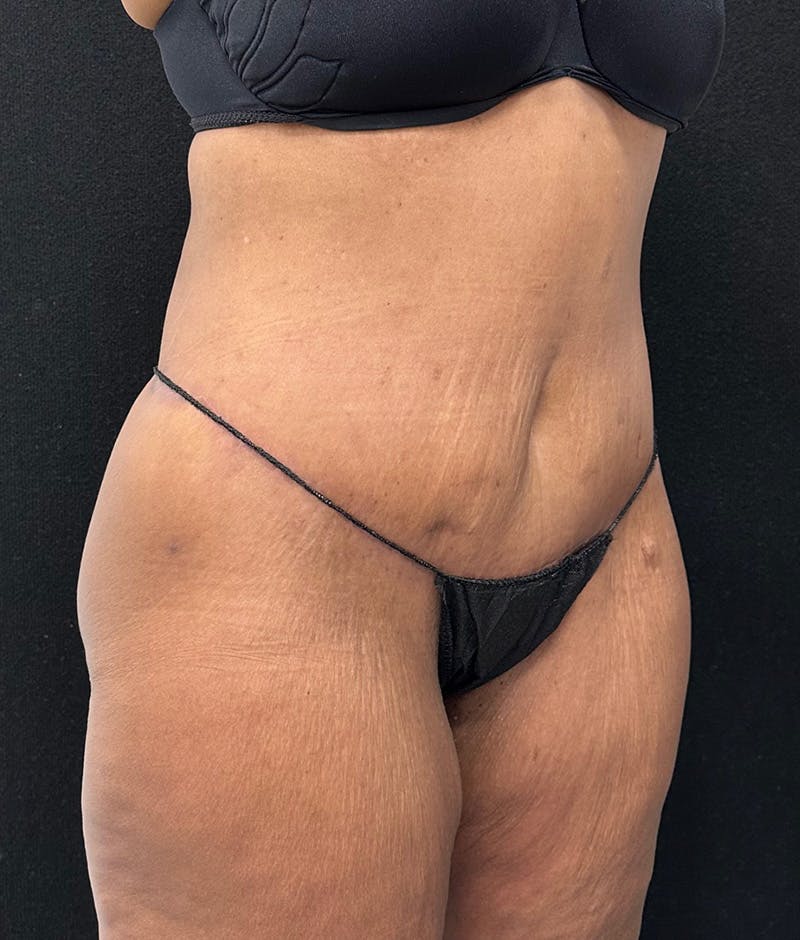 Lower Body Lift Before & After Gallery - Patient 148467571 - Image 4