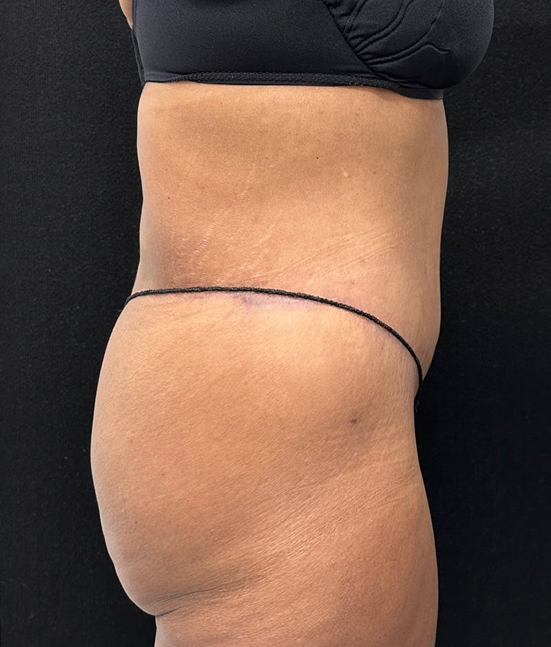 Lower Body Lift Before & After Gallery - Patient 148467571 - Image 6
