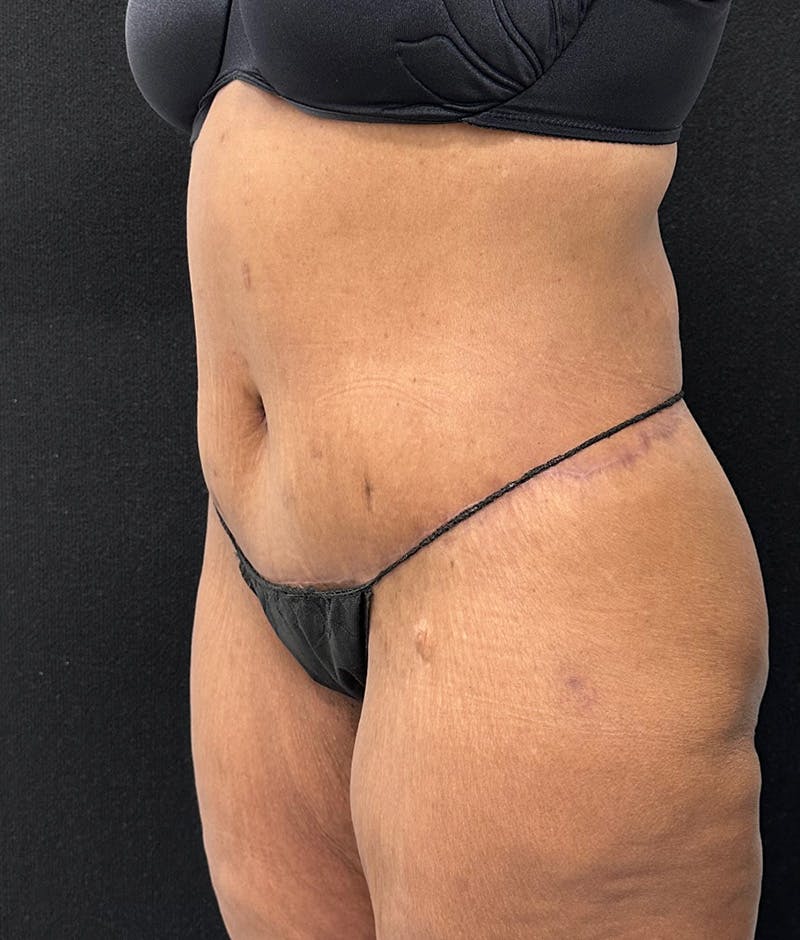 Lower Body Lift Before & After Gallery - Patient 148467571 - Image 8