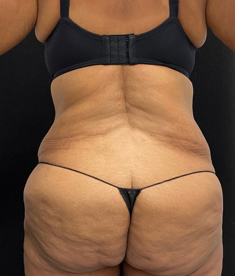 Lower Body Lift Before & After Gallery - Patient 148467571 - Image 11