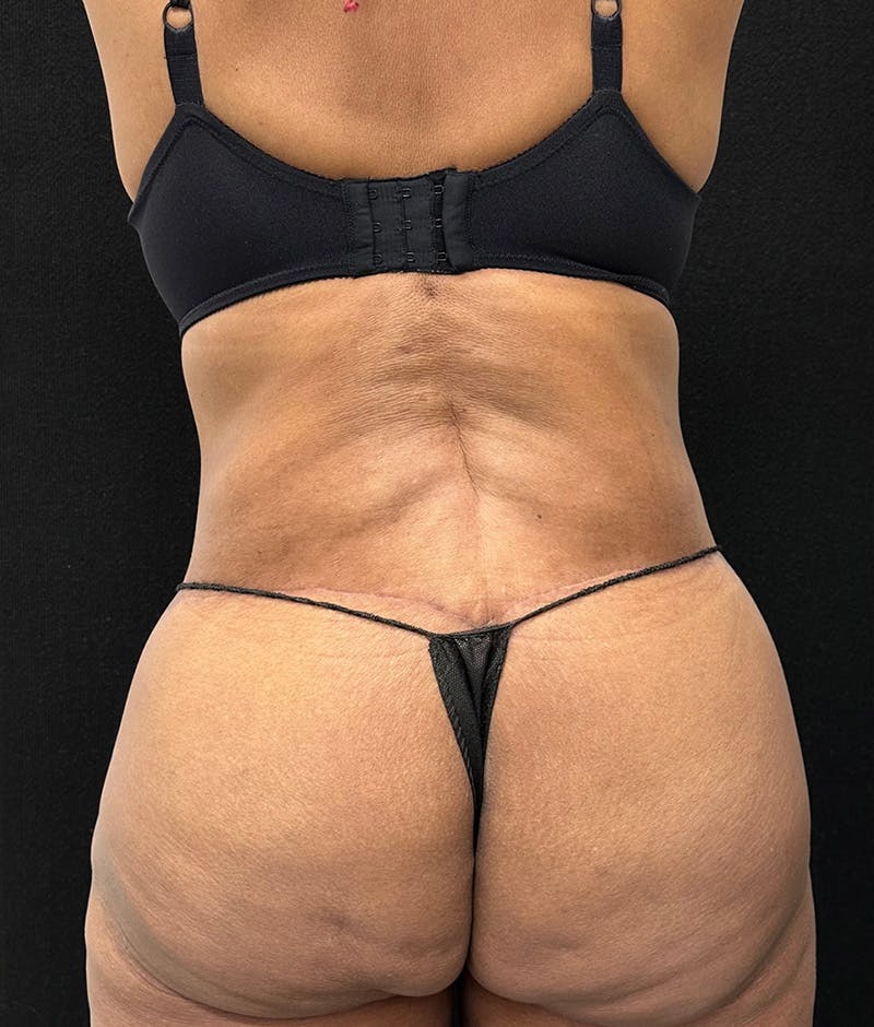 Lower Body Lift Before & After Gallery - Patient 148467571 - Image 12