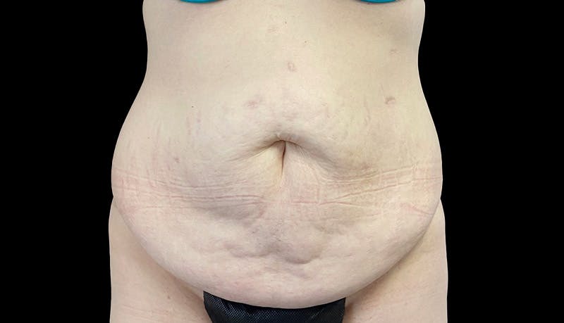 Abdominoplasty Before & After Gallery - Patient 148678281 - Image 1