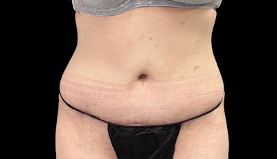 Abdominoplasty Before & After Gallery - Patient 148678281 - Image 2