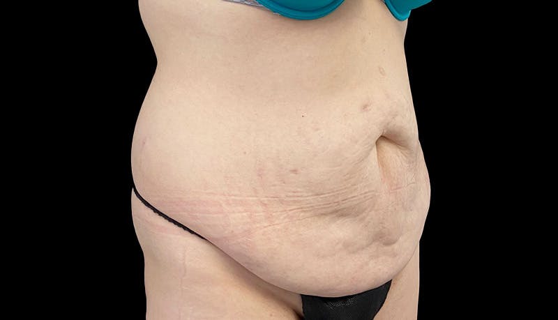 Abdominoplasty Before & After Gallery - Patient 148678281 - Image 3