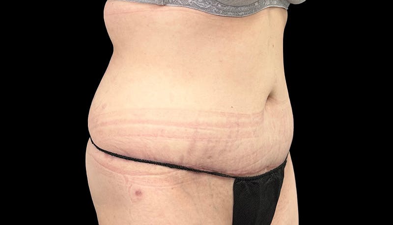 Abdominoplasty Before & After Gallery - Patient 148678281 - Image 4