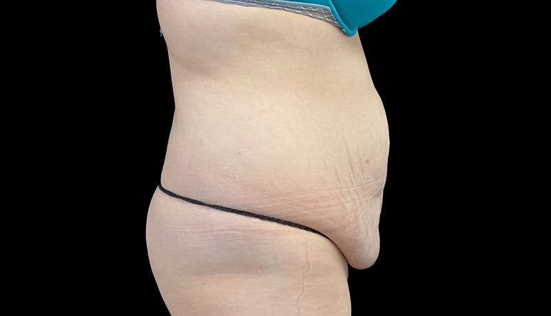 Abdominoplasty Before & After Gallery - Patient 148678281 - Image 5