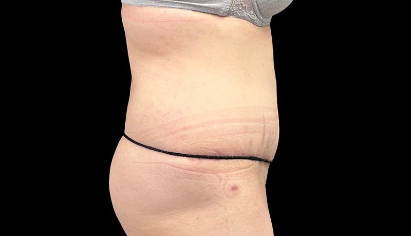 Abdominoplasty Before & After Gallery - Patient 148678281 - Image 6