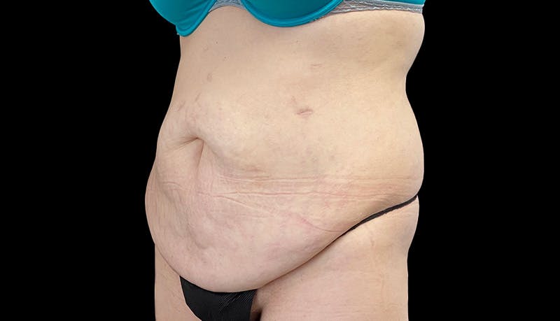 Abdominoplasty Before & After Gallery - Patient 148678281 - Image 7